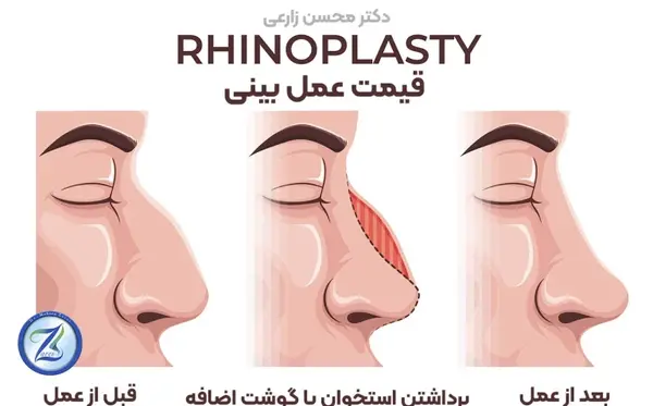 عکس آتلیه ای برای عمل بینی