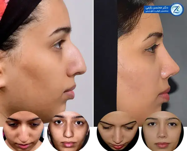 عکس آتلیه برای عمل بینی