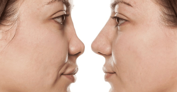 عکس آتلیه برای عمل بینی