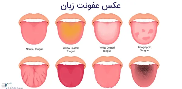 عکس زبان کودک سالم