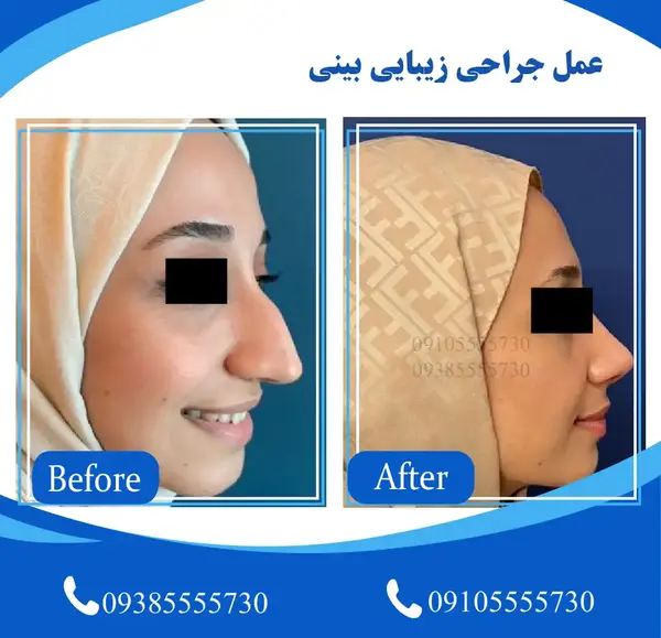 هزینه عکس آتلیه برای جراحی بینی
