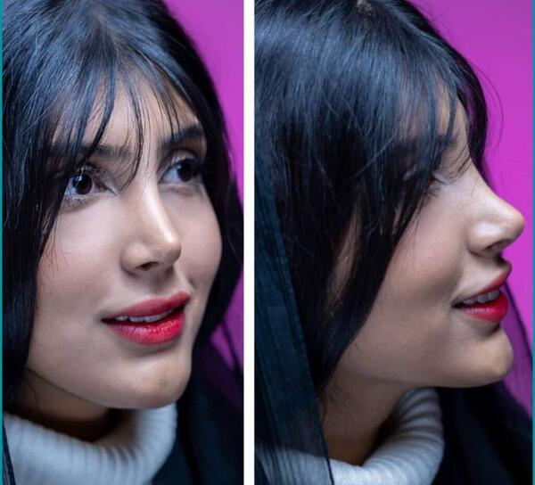 هزینه عکس آتلیه برای جراحی بینی
