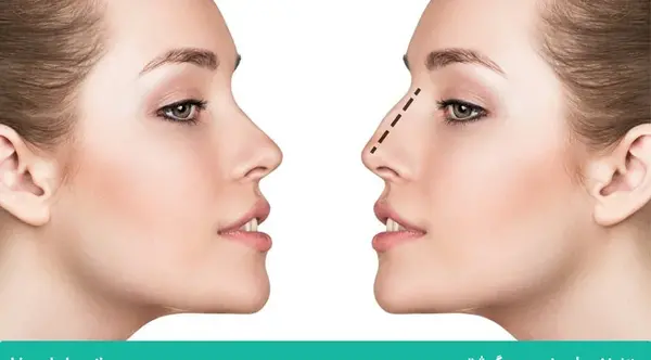 هزینه عکس آتلیه برای جراحی بینی