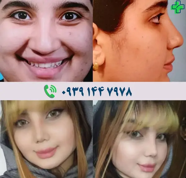 هزینه عکس آتلیه برای جراحی بینی