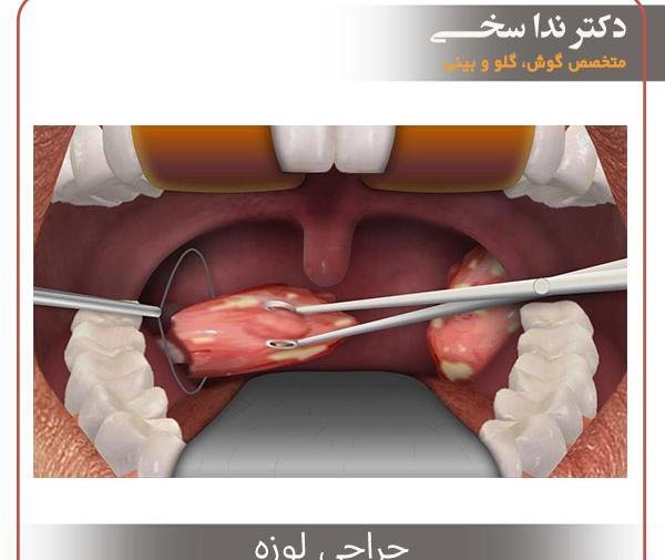 عکس لوزه سالم کودک