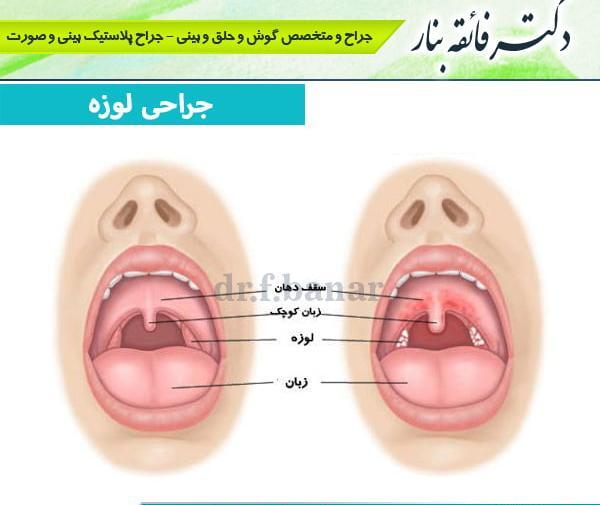 عکس لوزه سالم کودک