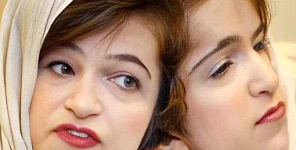 عکس لاله و لادن دوقلوهای به هم چسبیده