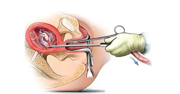عکس جنین سقط شده دختر نی نی سایت