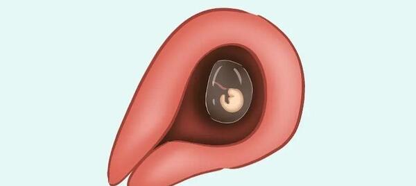 عکس جنین سقط شده یک ماهه دختر