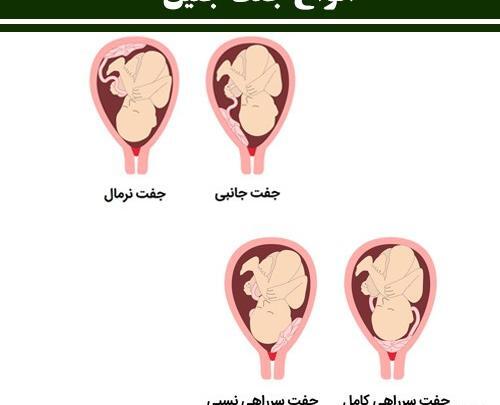 عکس جفت جنین یک ماهه سقط شده