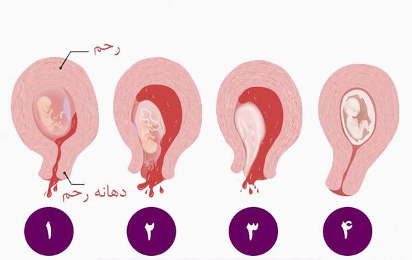 عکس جفت جنین یک ماهه سقط شده