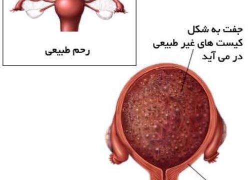 عکس جفت جنین یک ماهه سقط شده