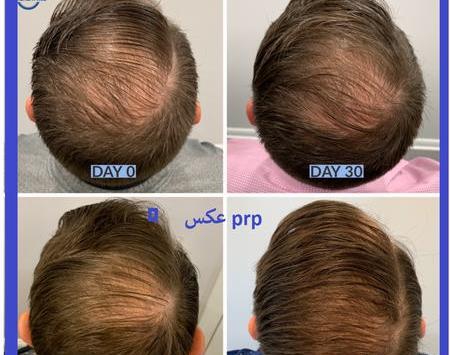 عکس پی آر پی