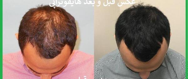 عکس پی آر پی