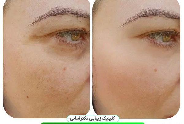 عکس پی آر پی