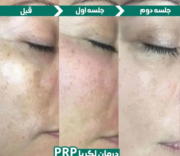 عکس پی آر پی