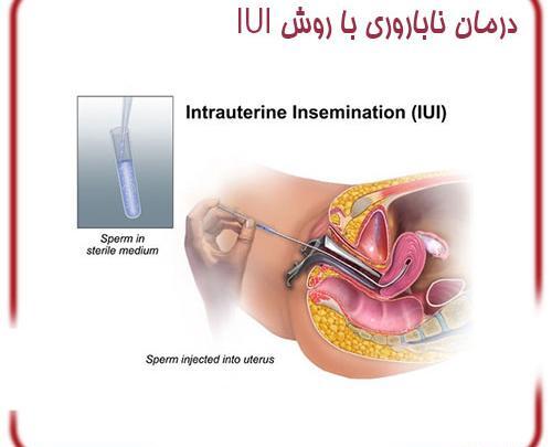 عکس عمل ای وی اف