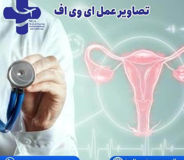 عکس عمل ای وی اف