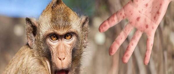 عکس آبله میمونی در کودکان