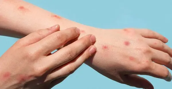 عکس آبله میمون در کودکان نی نی سایت