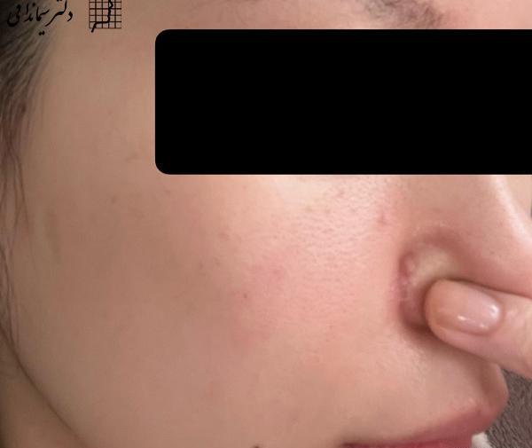 عکس داخل بینی بعد از عمل