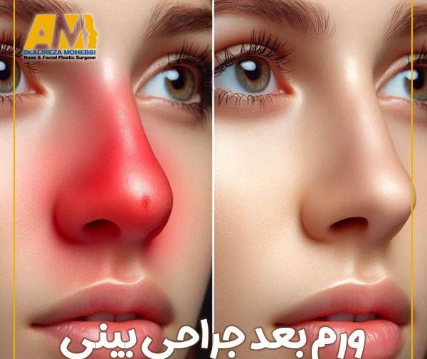 عکس داخل بینی بعد از عمل
