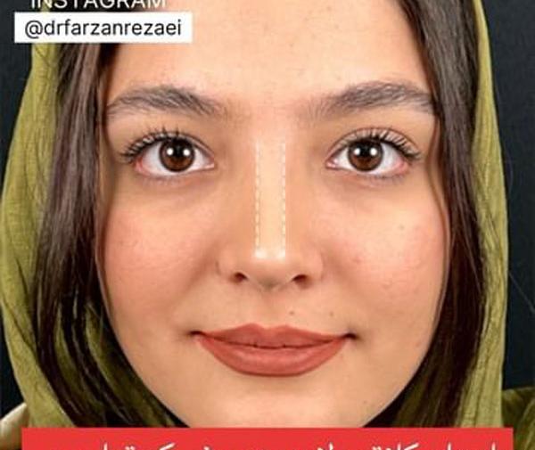 عکس داخل بینی بعد از عمل
