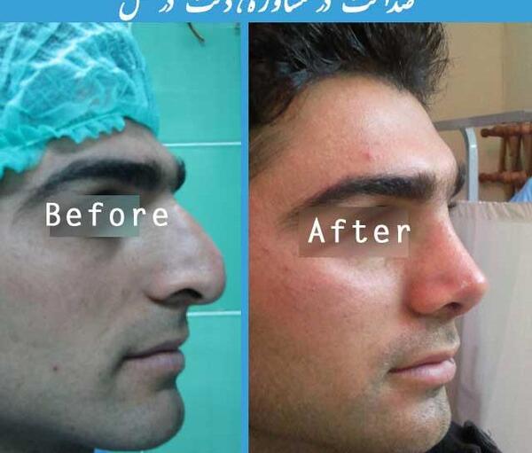 عکس داخل بینی بعد از عمل
