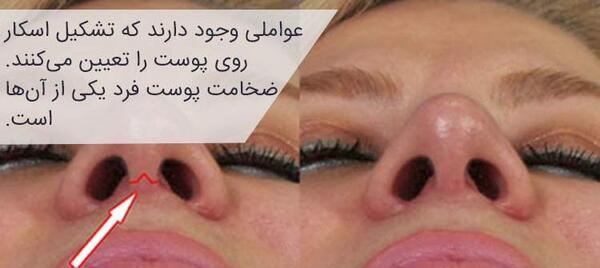 عکس داخل بینی بعد از عمل