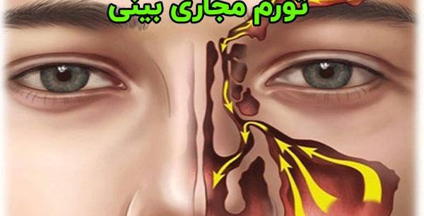 عکس داخل بینی بعد از عمل