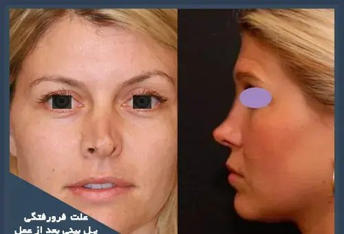عکس داخل بینی بعد از عمل