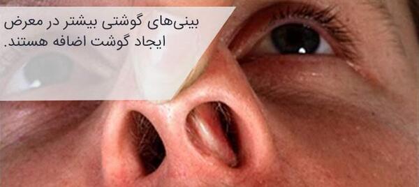 عکس داخل بینی بعد از عمل