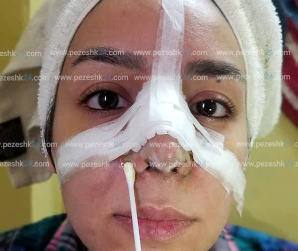 عکس داخل بینی عمل شده