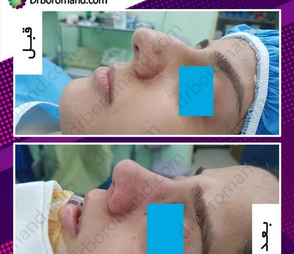 عکس داخل بینی عمل شده