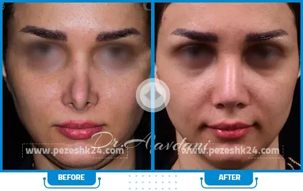 عکس داخل بینی عمل شده