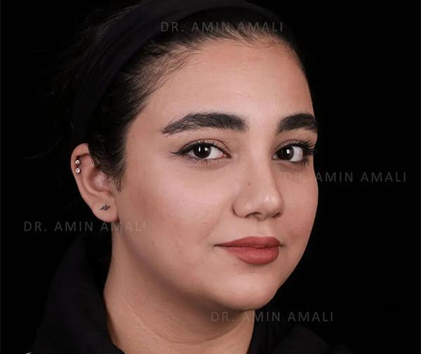 عکس داخل بینی عمل شده