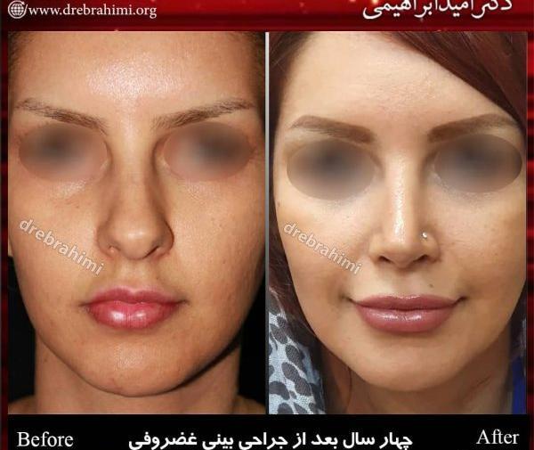 عکس داخل بینی عمل شده