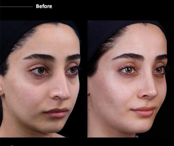 عکس داخل بینی طبیعی