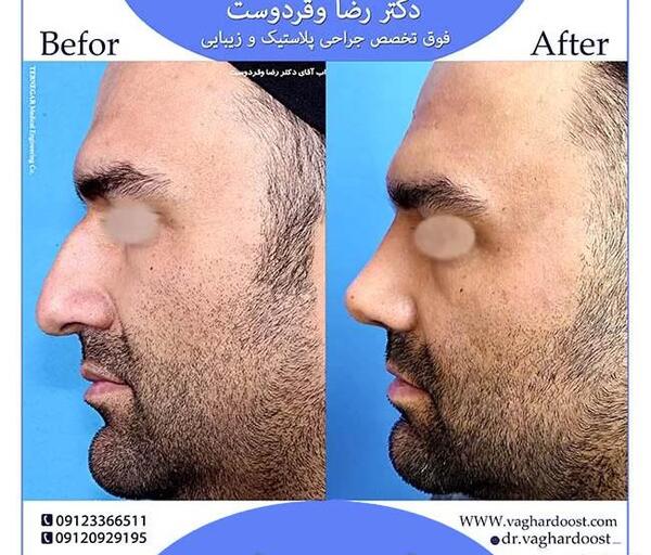 عکس داخل بینی طبیعی