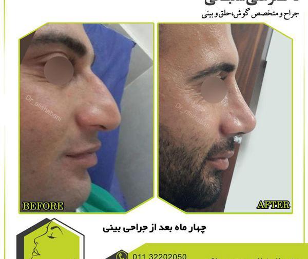 عکس داخل بینی طبیعی