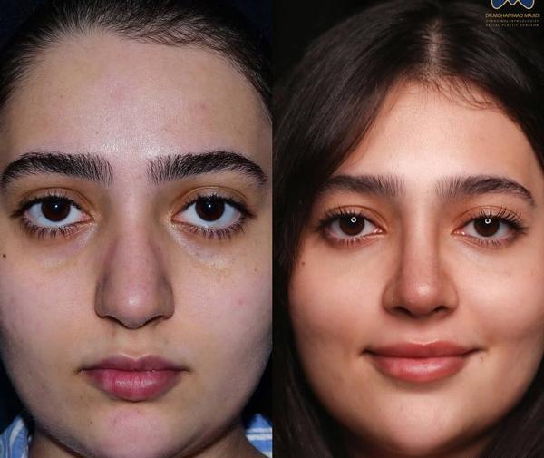 عکس داخل بینی طبیعی