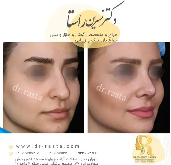 عکس داخل بینی طبیعی