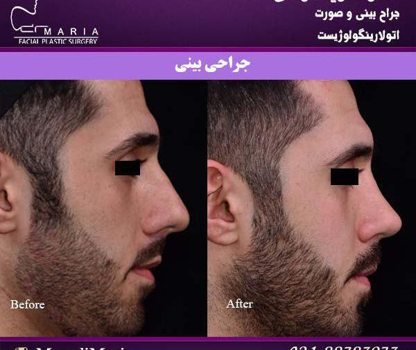 عکس داخل بینی طبیعی