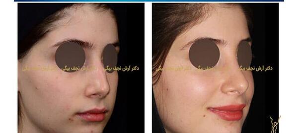 عکس داخل بینی طبیعی