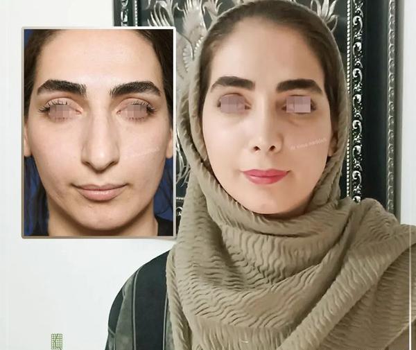عکس داخل بینی طبیعی