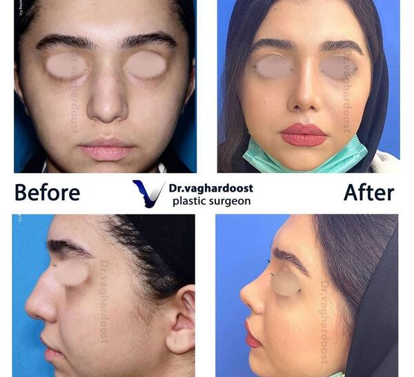 عکس داخل بینی طبیعی