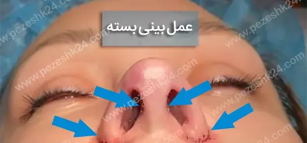 عکس از داخل دماغ