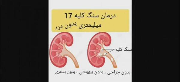 عکس سنگ کلیه ۲۵ میلیمتری