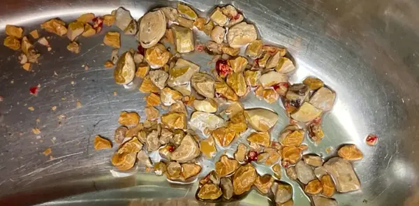 عکس سنگ کلیه ۲۵ میلیمتری