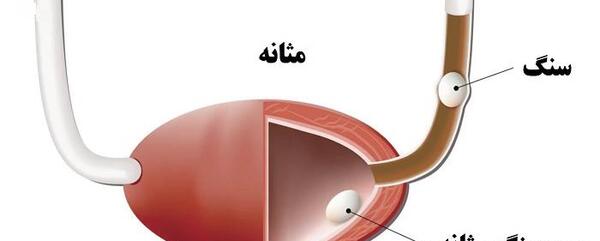 عکس سنگ کلیه خاردار